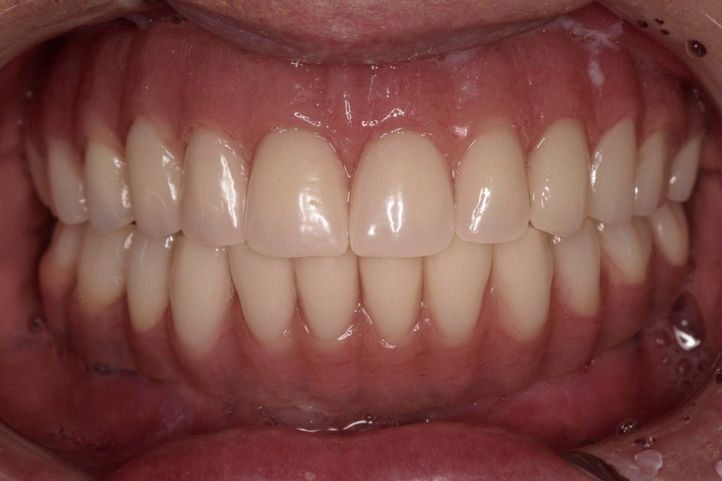 All-on-4® Treatment