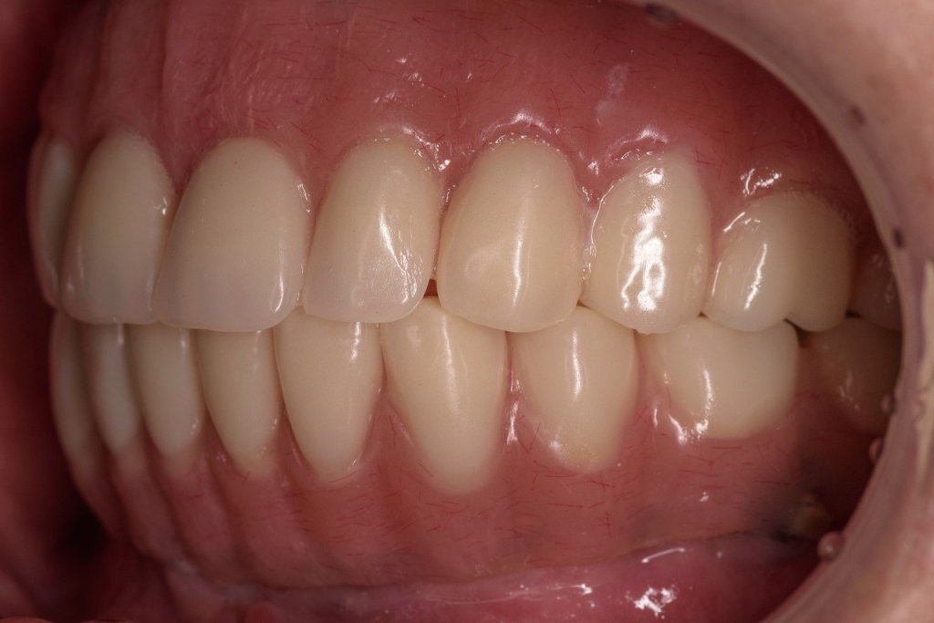 All-on-4® Treatment