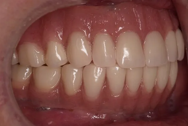 All-on-4® Treatment