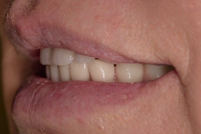 All-on-4® Treatment