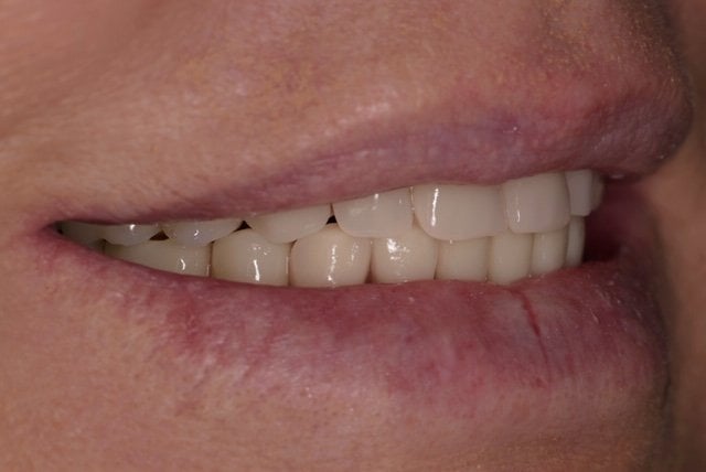 All-on-4® Treatment
