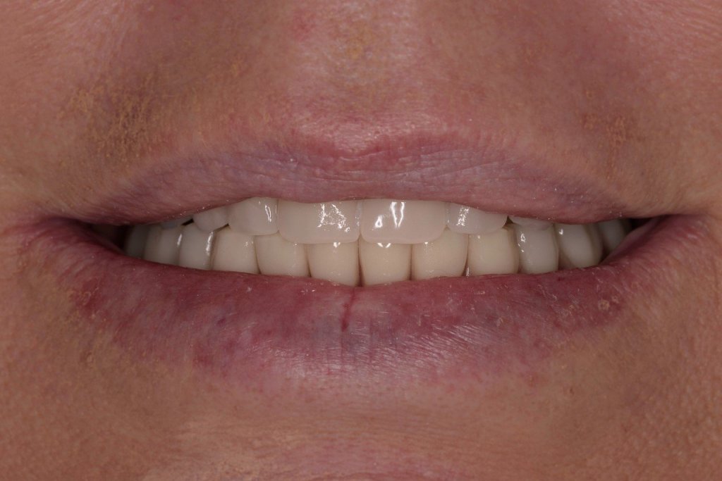 All-on-4® Treatment