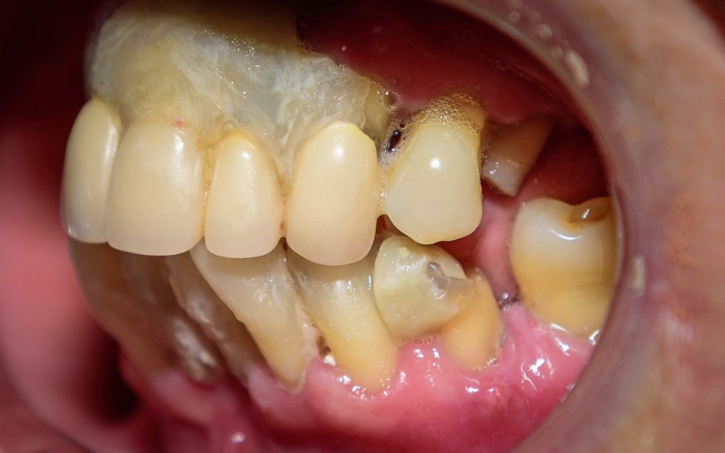 All-on-4® Treatment