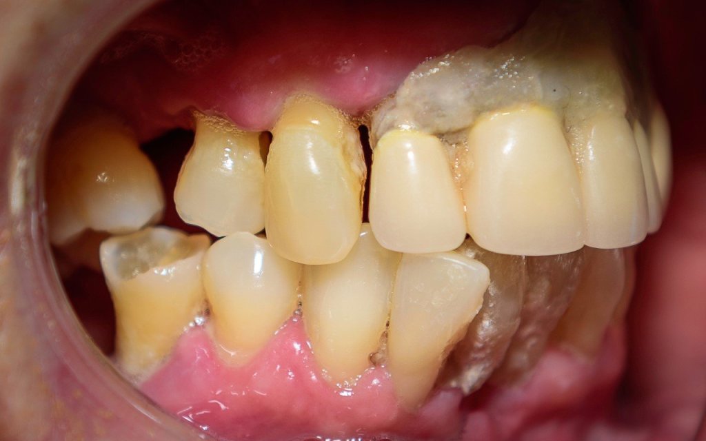 All-on-4® Treatment