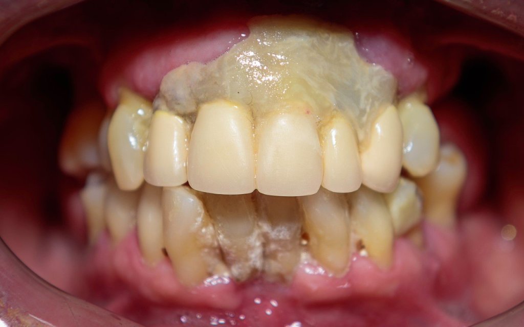 All-on-4® Treatment
