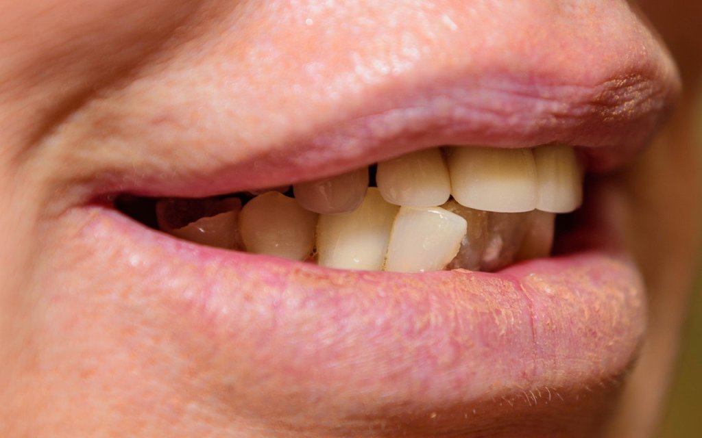 All-on-4® Treatment