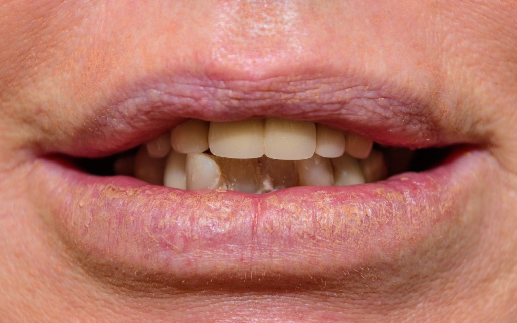 All-on-4® Treatment
