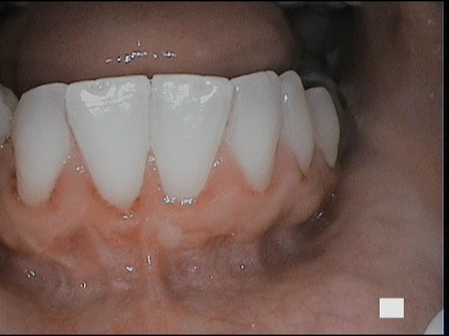 Treatment of Receding Gums