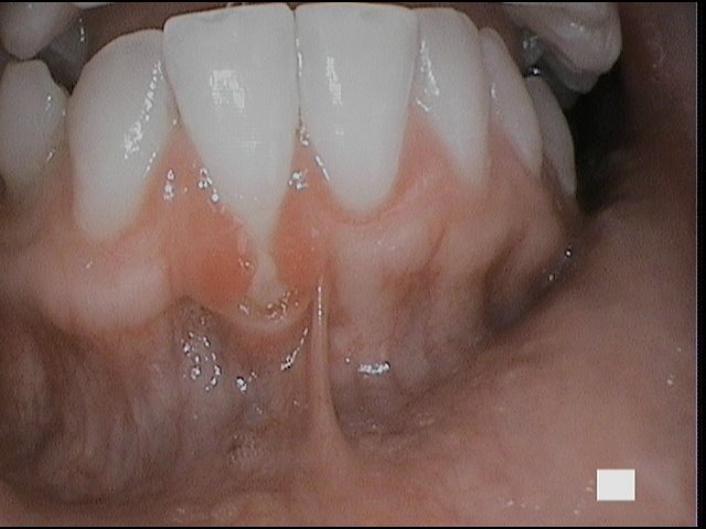 Treatment of Receding Gums