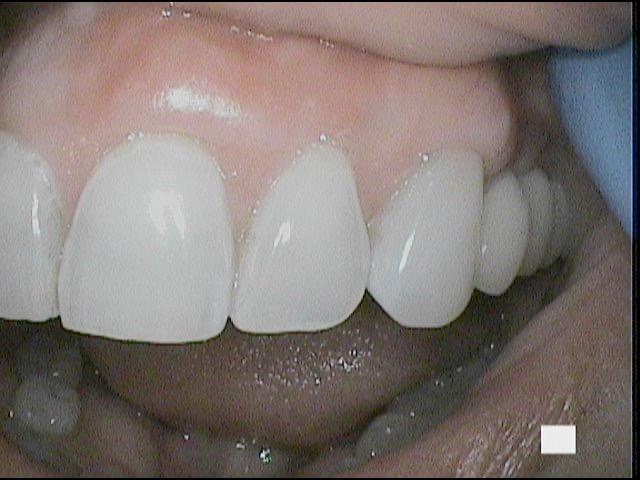 Treatment of Receding Gums