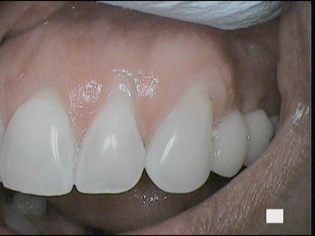 Treatment of Receding Gums