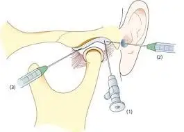 TMJ illustration of minimally invasive solutions