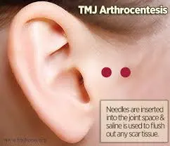 Photo of an ear and the TMJ area