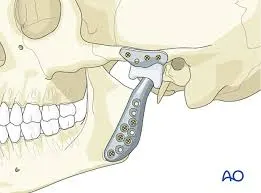 TMJ illustration of bite correction surgery