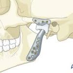 TMJ illustration of bite correction surgery