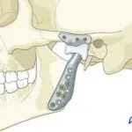 TMJ illustration of bite correction surgery