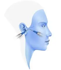 Illustration of TMJ Arthrocentesis