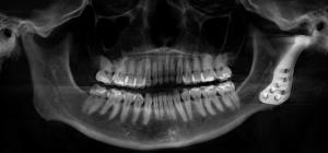 panoramic X-ray of upper and lower jaws
