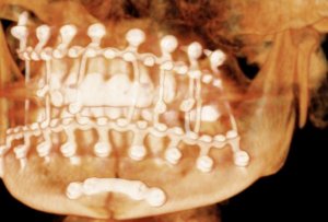 Xray of facial trauma patient