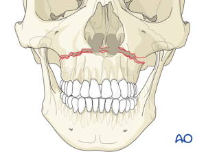 Illustration of a Maxilla (upper jaw) fracture