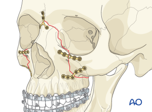 Illustration of a Maxilla (upper jaw) fracture repair
