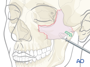 Illustration of a cheek bone fracture