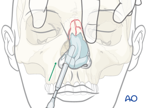 Illustration of nose bone fracture