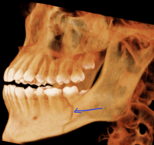 X-ray of the lower mandible facing left