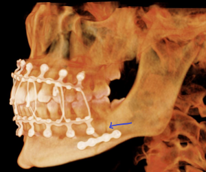X-ray of the lower mandible facing left with hardware