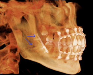 X-ray of the lower mandible facing right with hardware