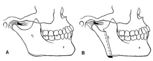 Illustration showing Condylotomy