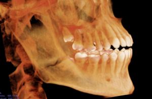 X-ray of the lower mandible facing right