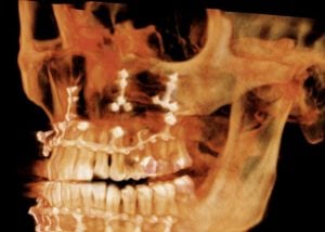 X-rays of a Maxilla (upper jaw) fracture repair