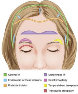 Brow lift illustration