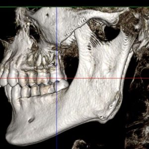 CT scan showing Coronoid Process Hyperplasia 