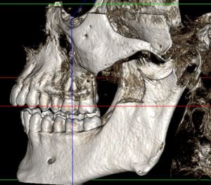CT scan showing Coronoid Process Hyperplasia alternate view
