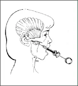 Illustration of Temporal tendonitis treatment technique