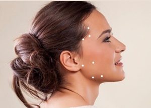 Photo showing potential botox injection sites