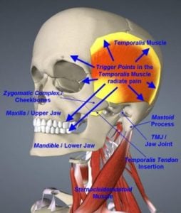 Illustration of Temporal tendonitis