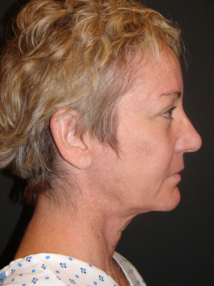 Neck Lift