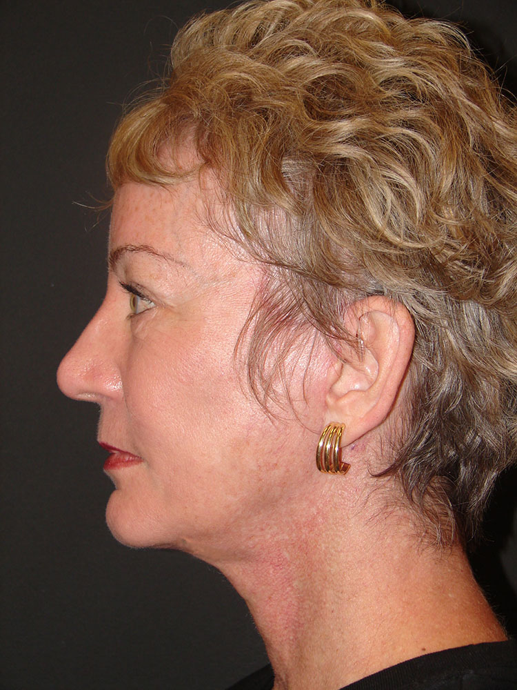 Neck Lift