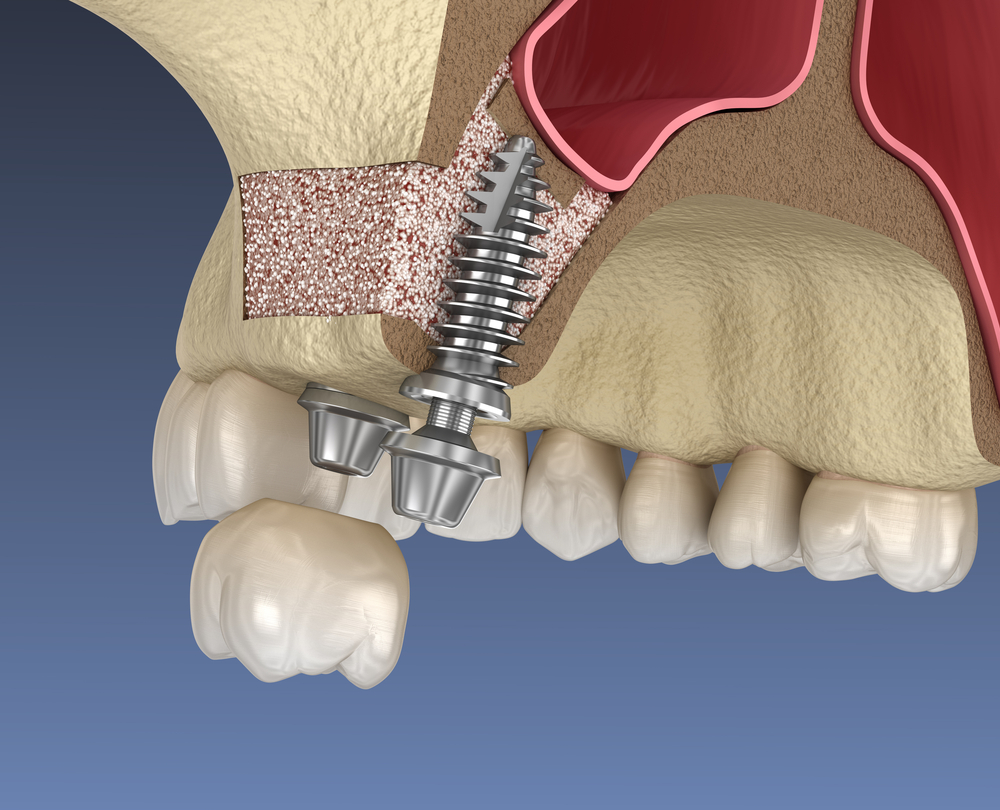 sinus lift illustration