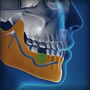 Nerve Repositioning Illustration