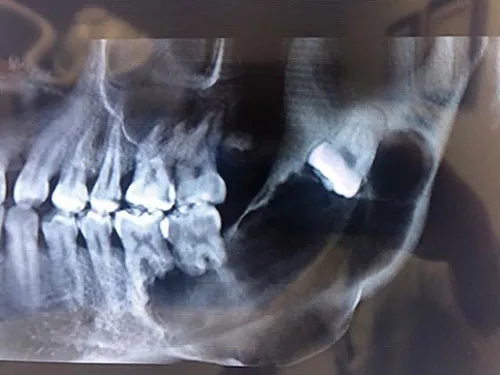 X-ray showing oral / maxillofacial pathology