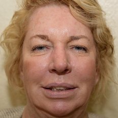 before Dental Implants