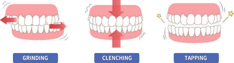 Illustration of types of Bruxism - grinding, clenching, tapping