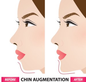 Illustration of chin implant surgery before and after