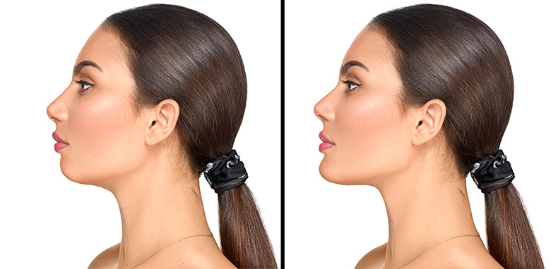 Chin implant surgery before and after