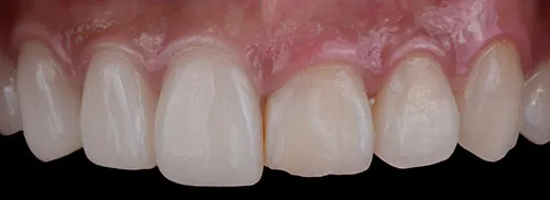 side by side example of crown lengthening before and after