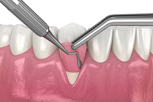 illustration of a gum graft